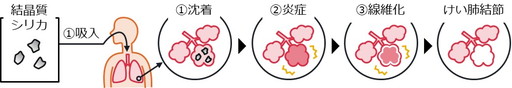 図１ けい肺の発症メカニズム