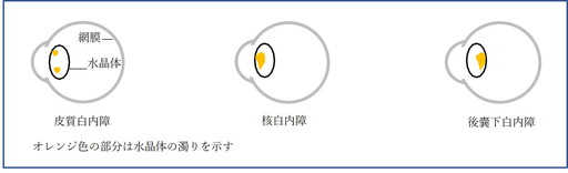 白内障と放射線に関する疫学研究